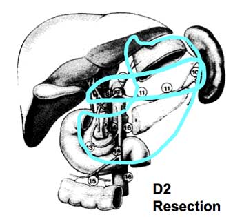 D2 resection