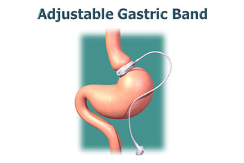 Adjustable Gastric Band