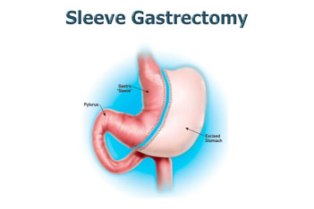 Sleeve Gastrectomy