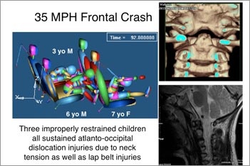 35 MPH Frontal Crash