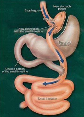 Gastric Bypass